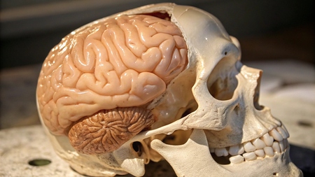 C'est le seul cas de cerveau figé dans le verre : découvrez comment c'est arrivé